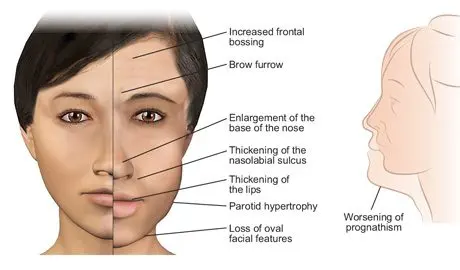 What is acromegaly?