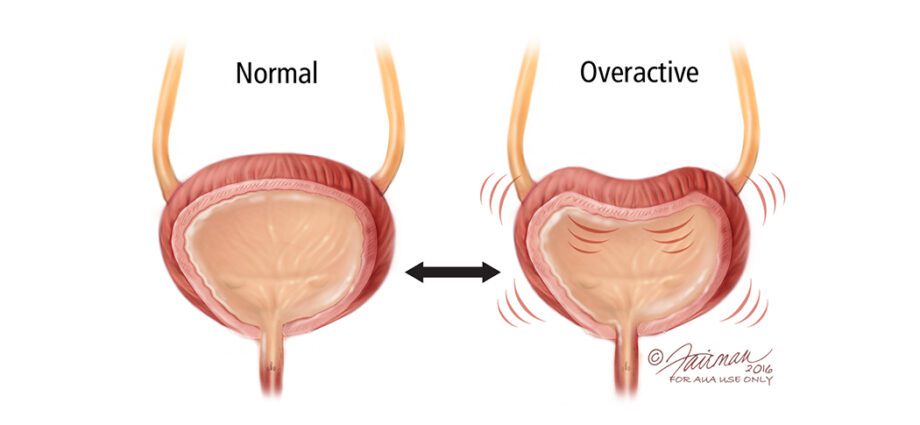 What is an overactive bladder?