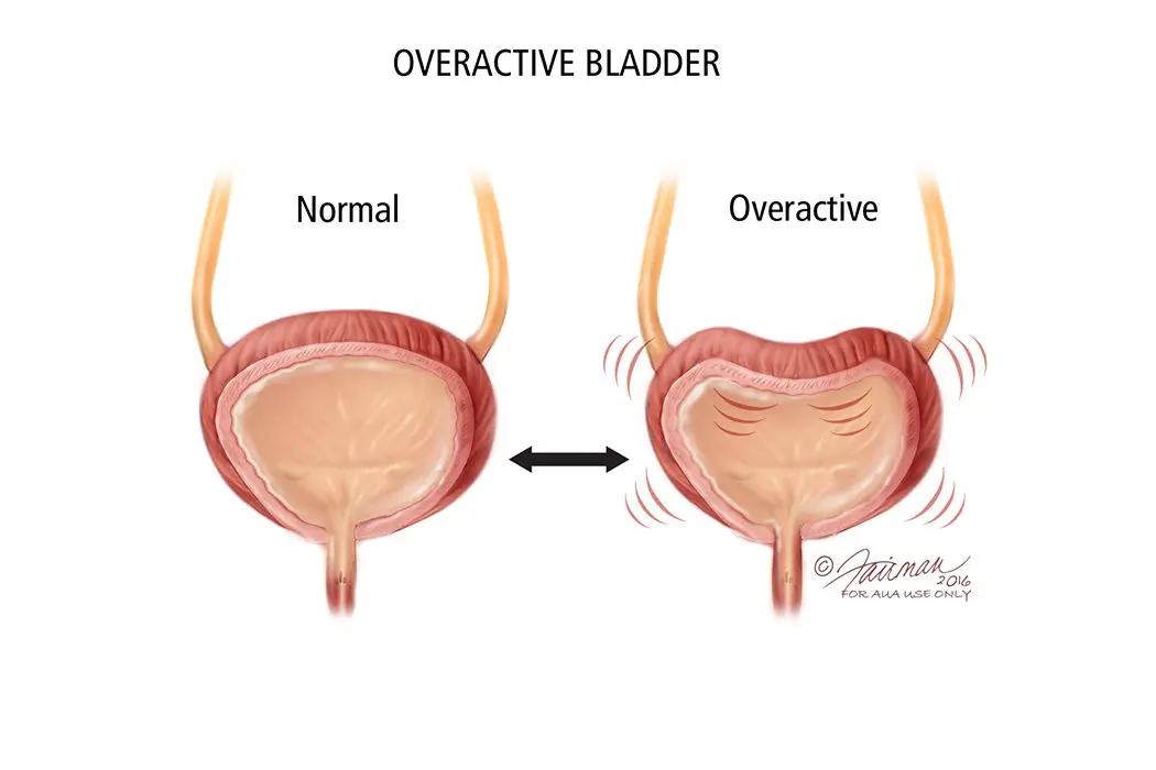 What is an overactive bladder?