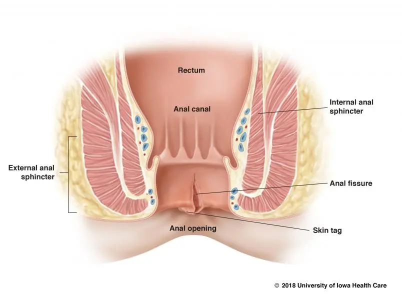 What is anal fissure?