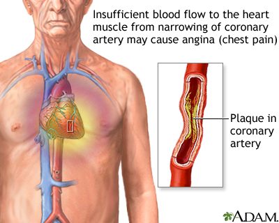 Wat is angina pectoris?