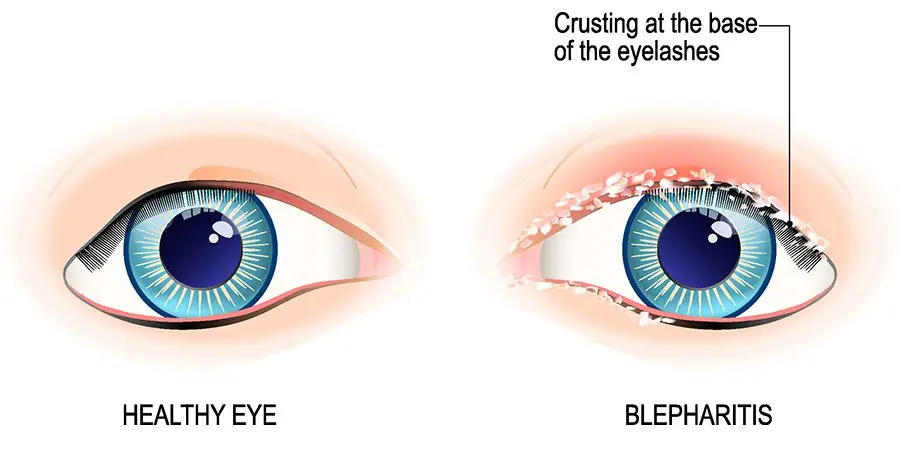 What is blepharitis?