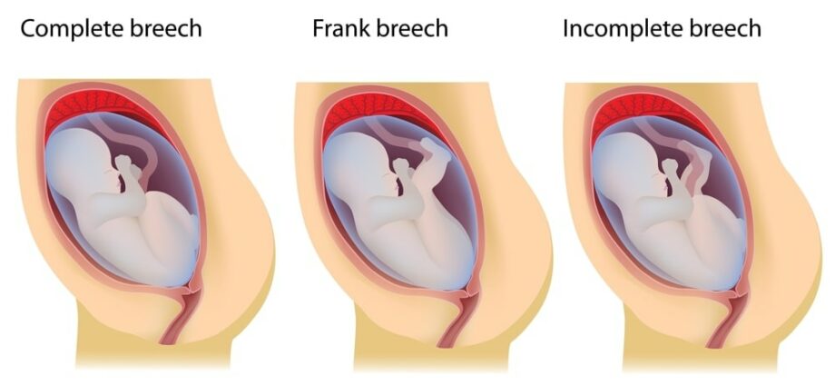 What is breech birth?