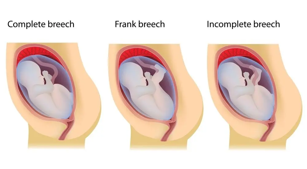 What is breech birth?