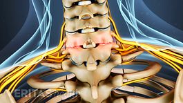 Što je cervikalni osteoartritis?