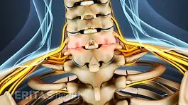 What is cervical osteoarthritis?