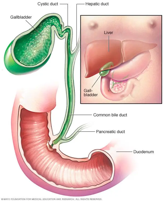 What is Cholecystitis?