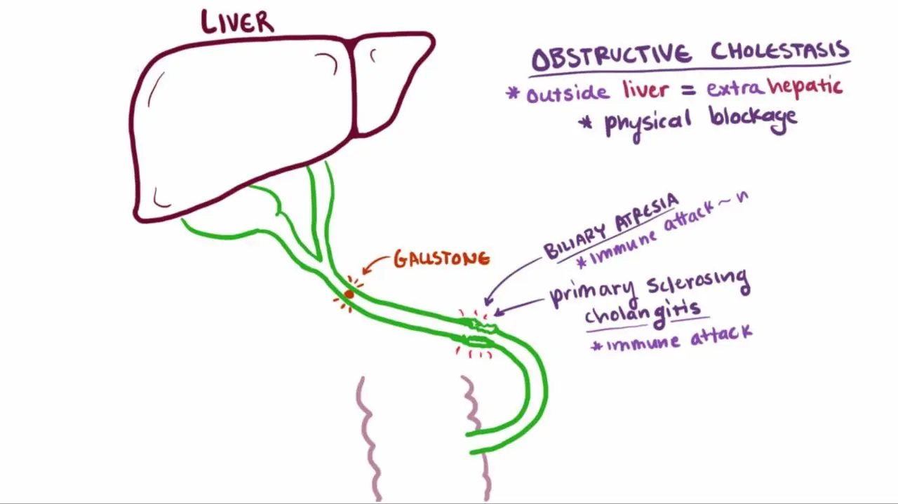 What is cholestasis