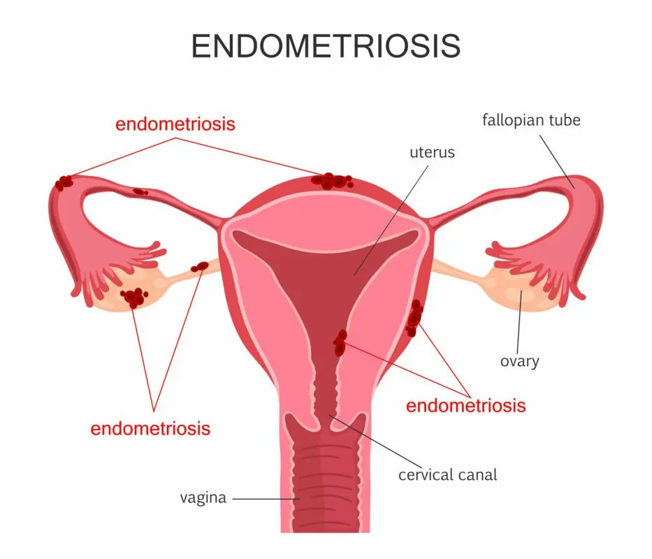 What is endometriosis and how to treat it: doctor&#8217;s advice