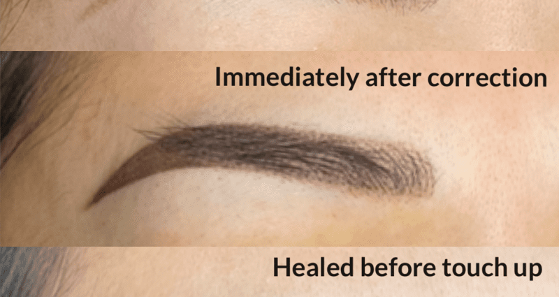 What is eyebrow correction for?