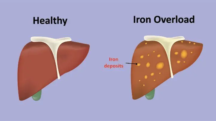 What is hemochromatosis