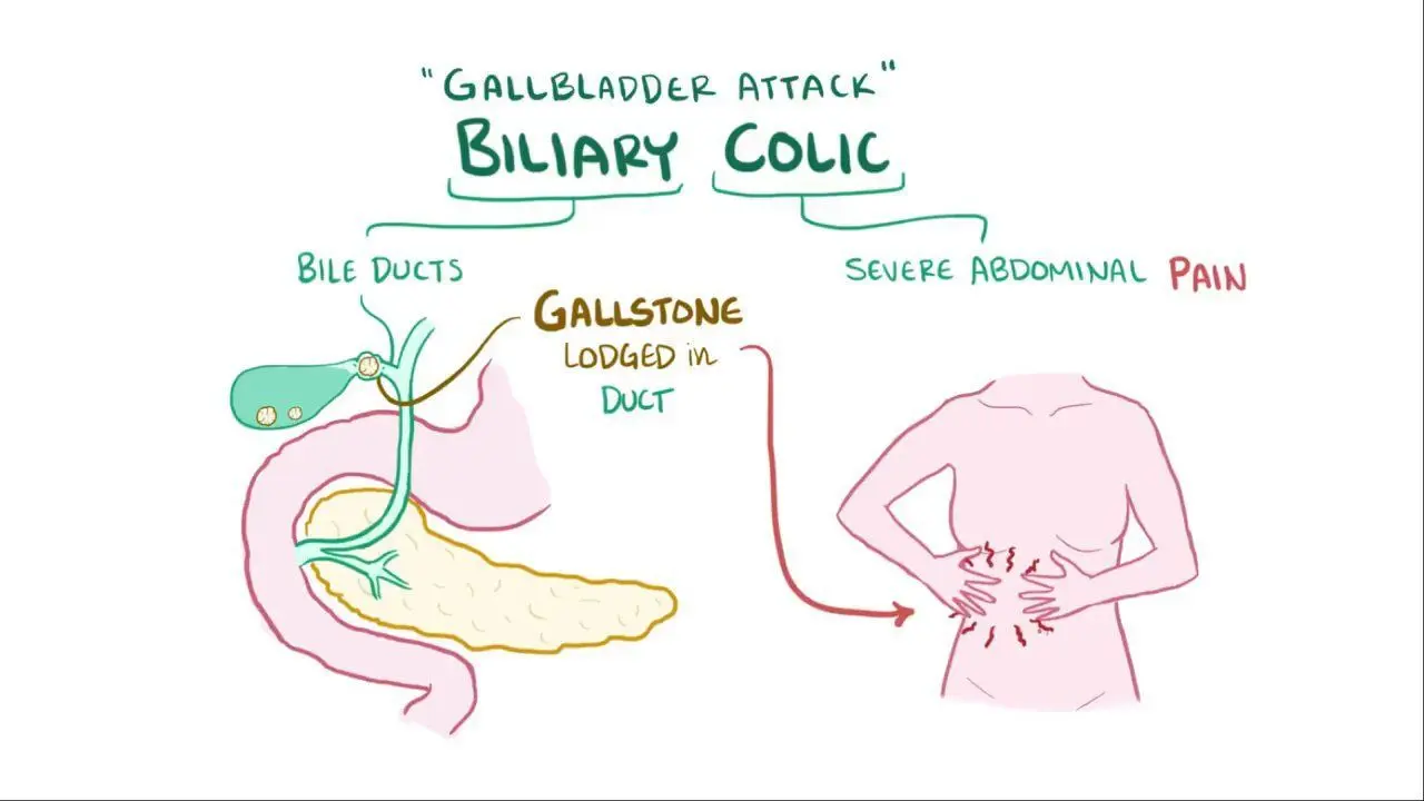 What is hepatic colic?