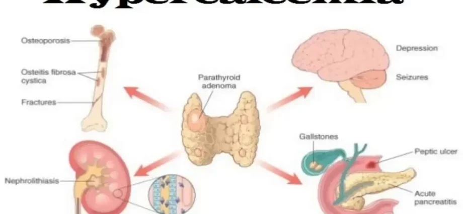 What is hypercalcemia?