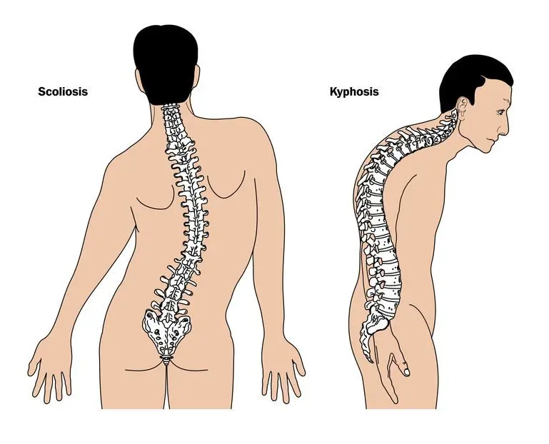 What is kyphosis?