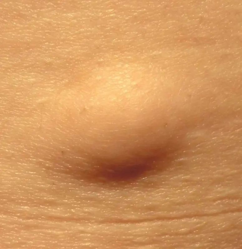 What is lipoma?