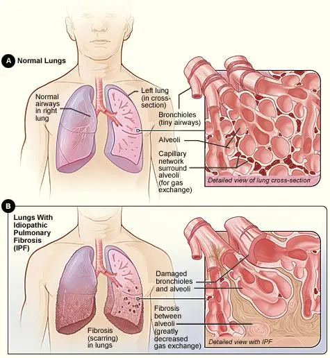 What is pulmonary fibrosis?