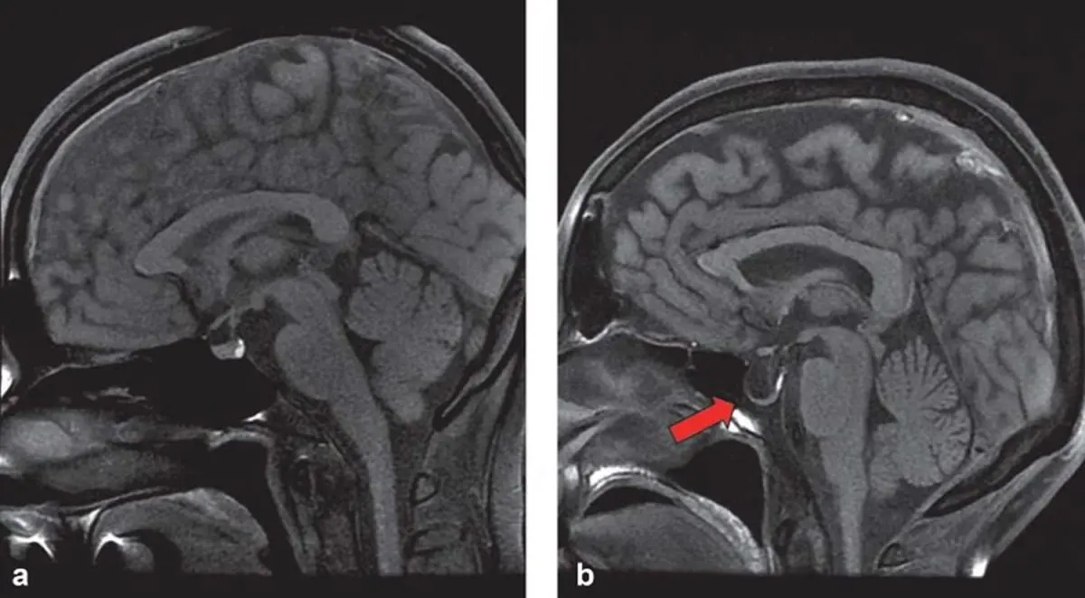 What is sella turcica syndrome?