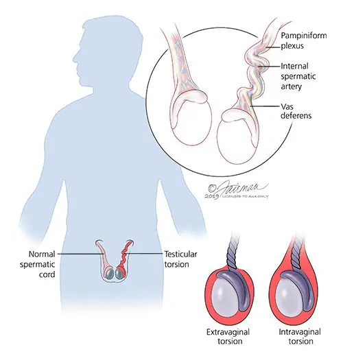 What is testicular torsion?