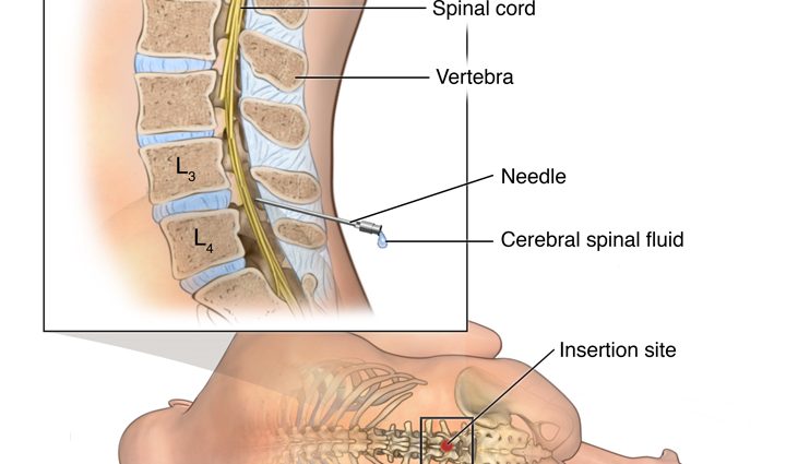 What is the myelogram?