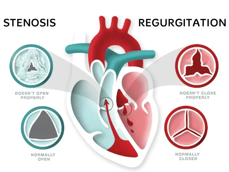 heart-valve-disease-symptoms-risk-factors-diagnosis-and-treatment