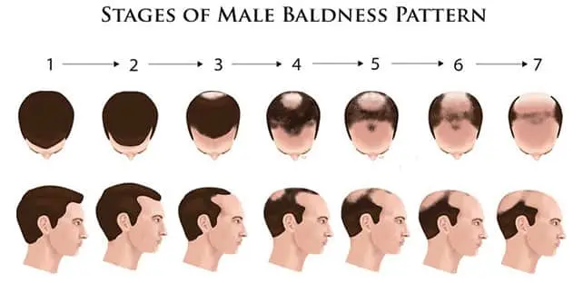 What procedures can cause baldness