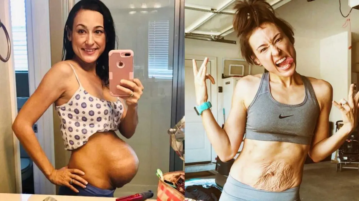 What the belly looks like after twins: real photos of moms