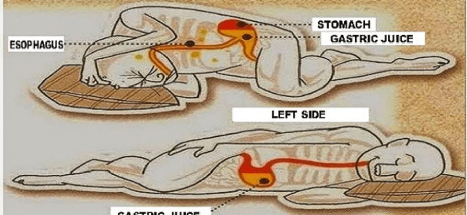 What to do if the left side becomes numb: the neurologist answers