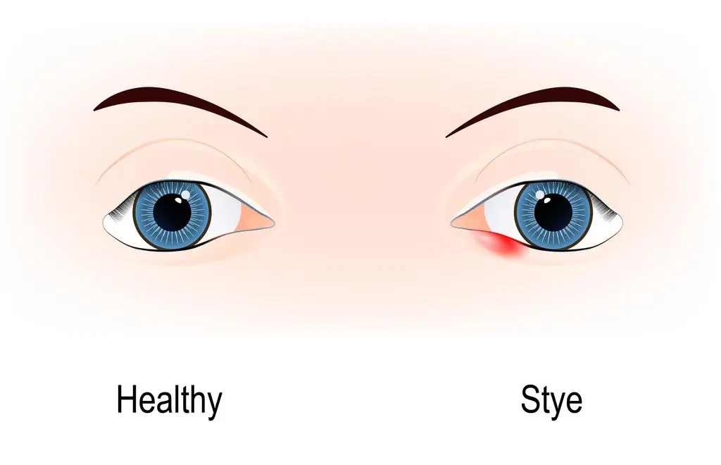 What to do if the lower eyelid is swollen and sore