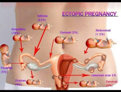 When and how an ectopic pregnancy manifests itself in the early stages