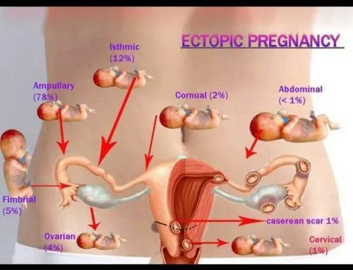 When and how an ectopic pregnancy manifests itself in the early stages