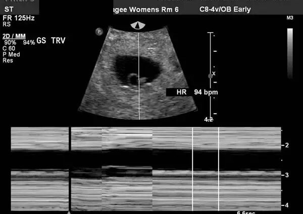 When it is possible to determine pregnancy by ultrasound: how long before the delay