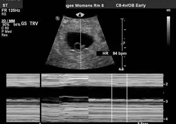 When it is possible to determine pregnancy by ultrasound: how long before the delay