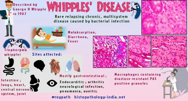 Whipple&#8217;s disease