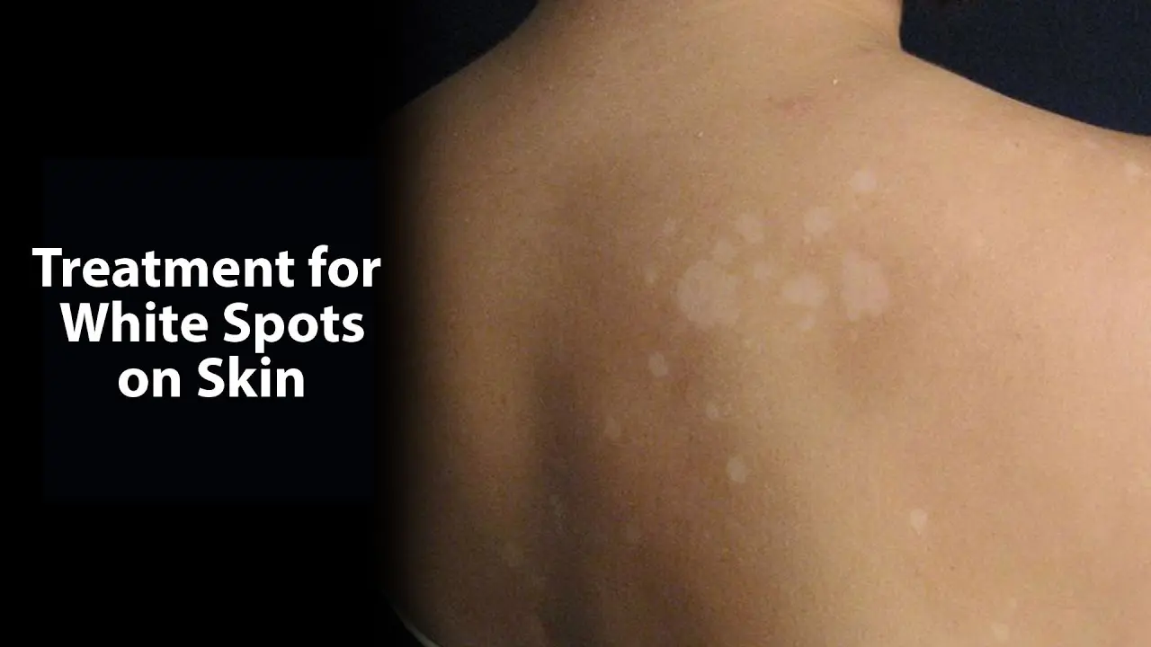 White spots on the skin: treatment. Video