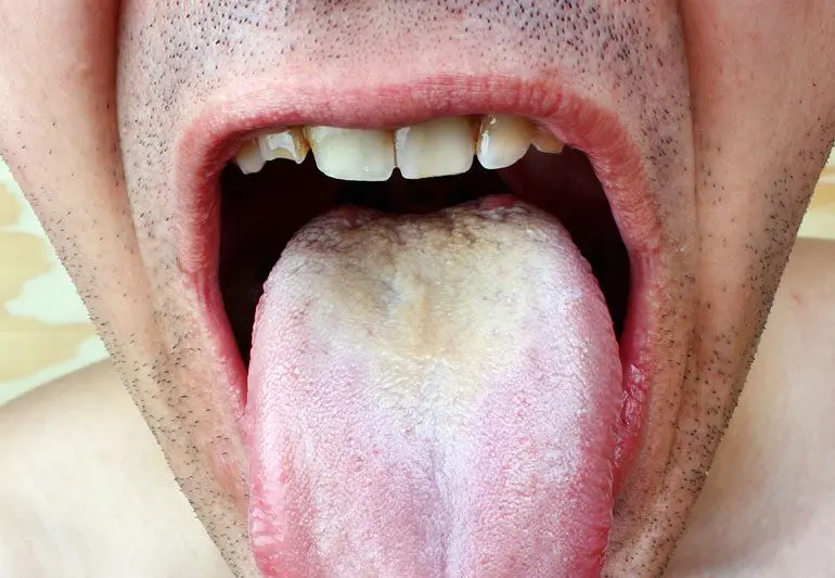 White tongue