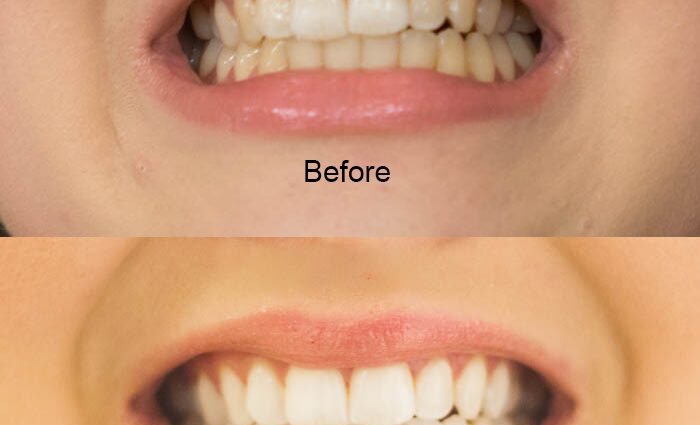 Whitening strips: pros and cons