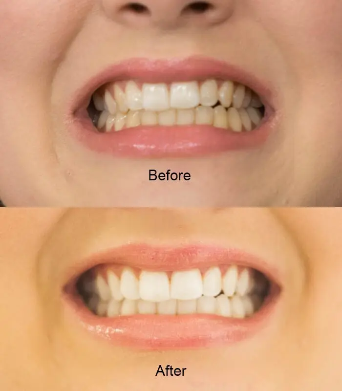 Whitening strips: pros and cons