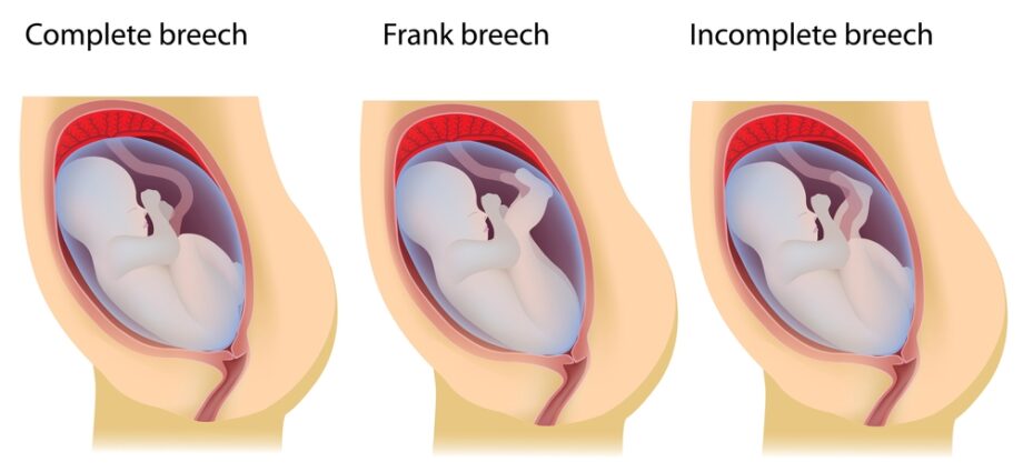 Why a caesarean section is better than natural childbirth &#8211; doctors