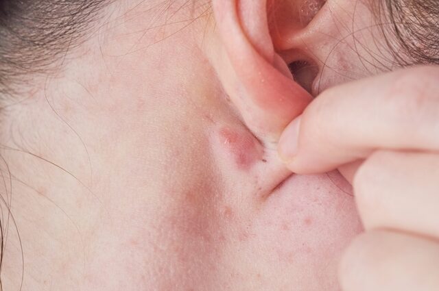 Warum kann ein Knoten hinter dem Ohr auftreten und wie kann man ihn loswerden?