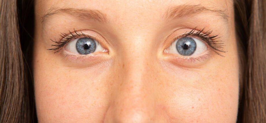 Why can strabismus appear in adults?