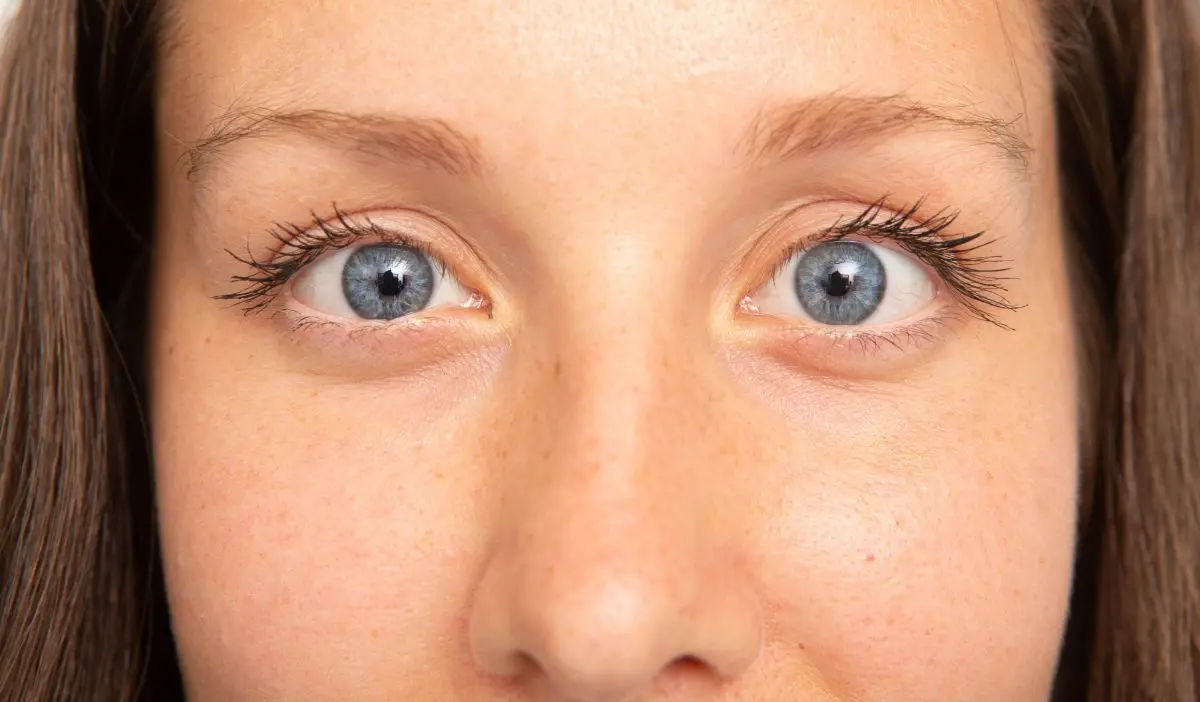 Why can strabismus appear in adults?