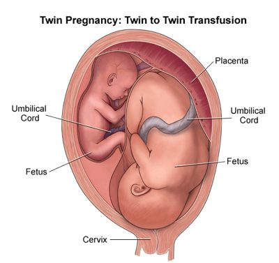 Why carrying twins is very dangerous: risks for mom and babies