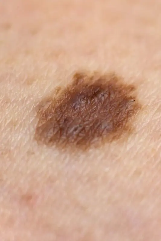 Why do many moles appear on the body and face with age?