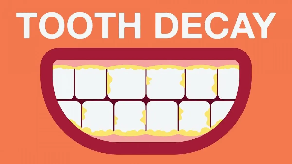 Why do teeth deteriorate? Video