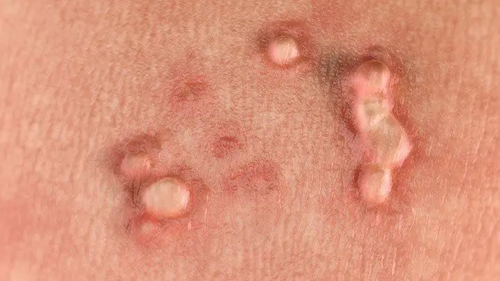 Why do warts appear after 30 years