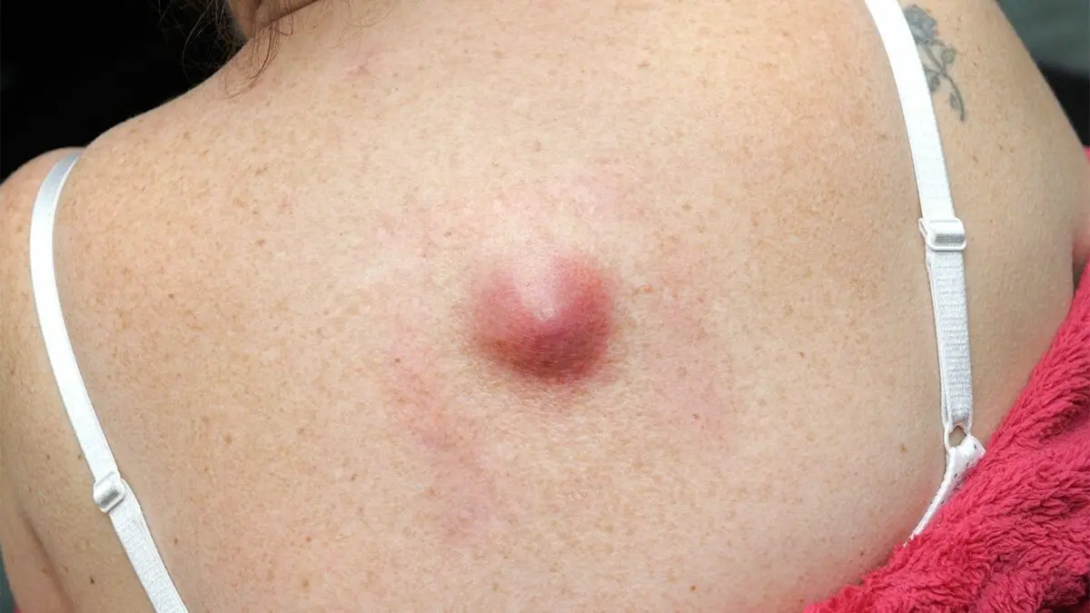 Why does a bump appear after a mosquito bite?