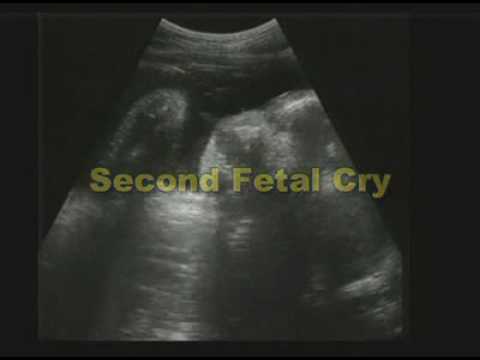 Why does the baby cry in the womb: video