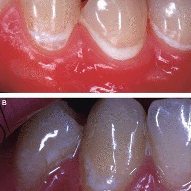 Why does white plaque appear on the lips in the morning: the doctor answers