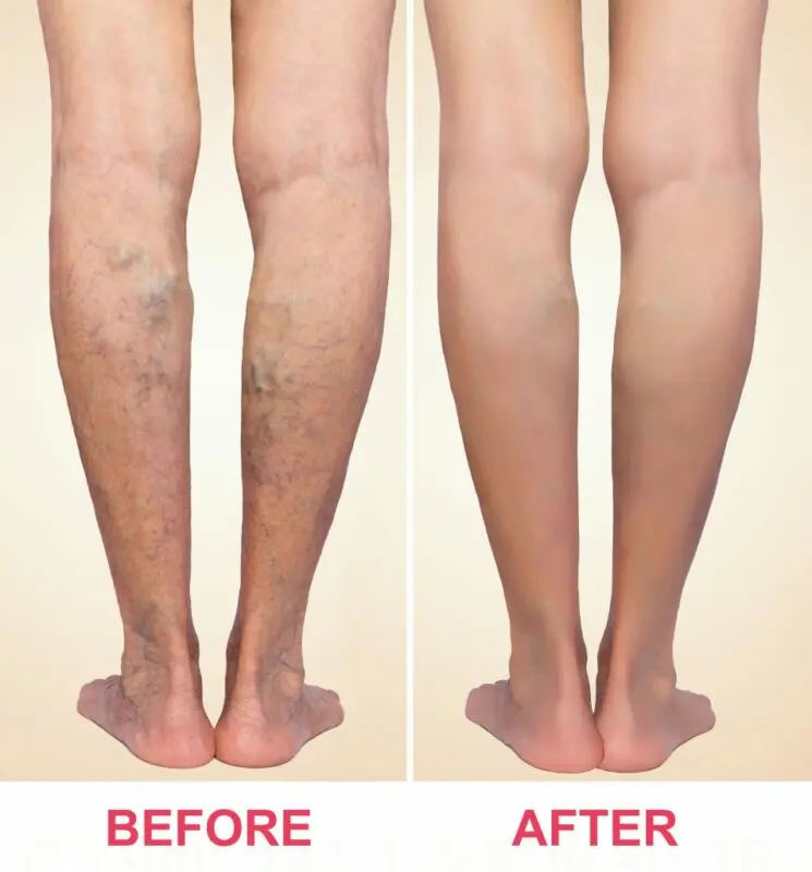 Why is varicose veins dangerous?