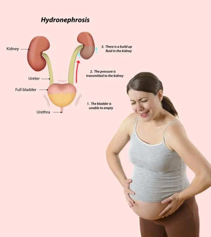 Why kidneys hurt during pregnancy